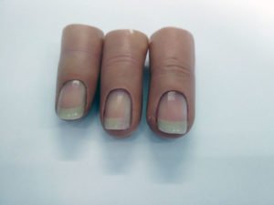 Proteza kosmetyczna palców, Protetica, Łódź, Zagajnikowa 35, poradnia protetyczna