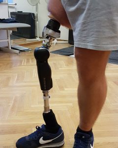 proteza nogi, nogi, rehabilitacja, Proteza kosmetyczna palców, Protetica, Łódź, Zagajnikowa 35, poradnia protetyczna